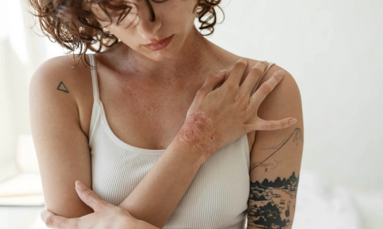 Žena s dermatitidou na předloktí dotýká postižené kůže.