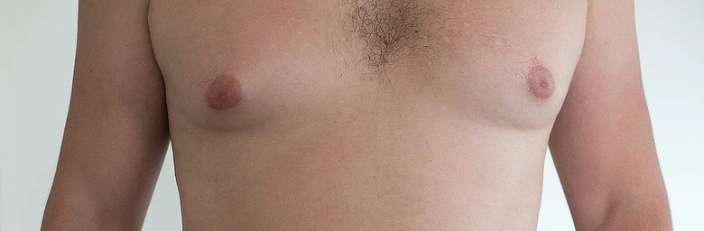 Mužský hrudník s gynekomastií, příznaky pro léčbu.