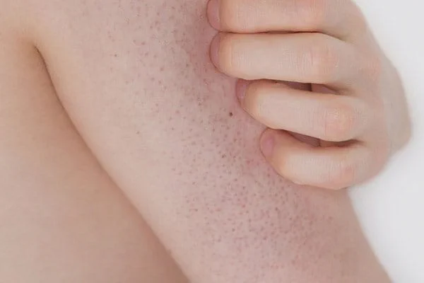 Keratosis pilaris skin condition