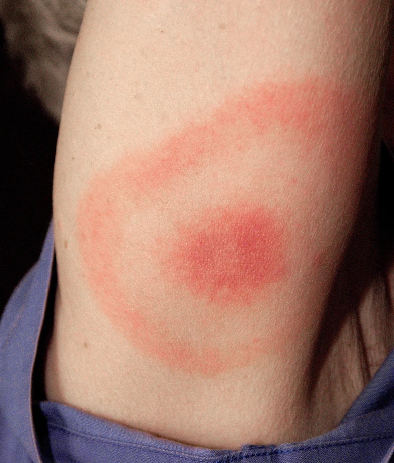 Fotografie červeného kruhového vyrážky na kůži jako příznak lymeské borreliózy.