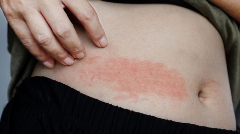Itchy skin rash on abdomen