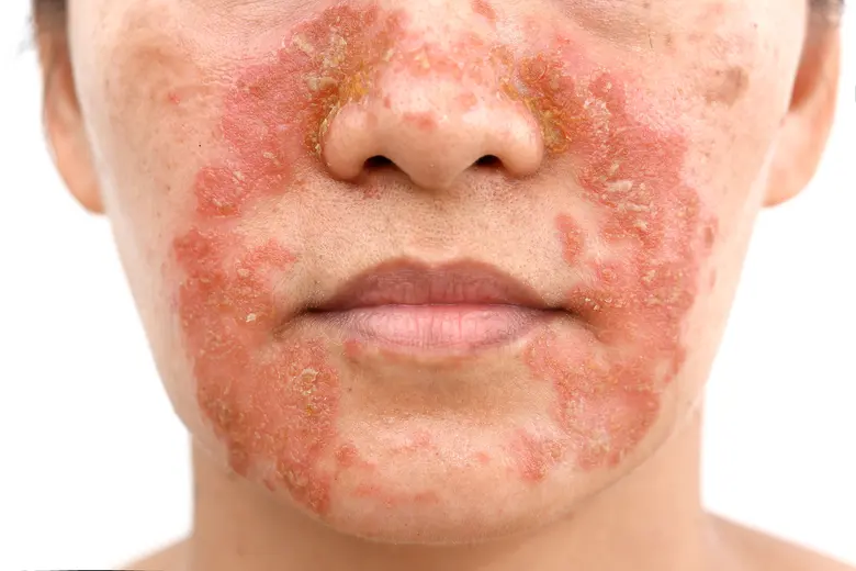 Příznaky seboroické dermatitidy na obličeji s červenými skvrnami.