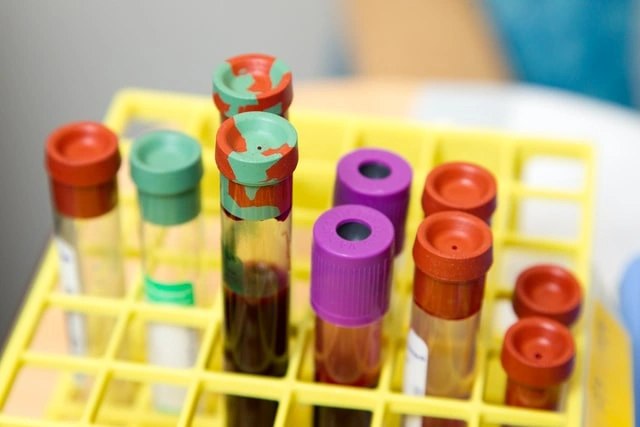 Žlutý stojan s zkumavkami pro laboratorní testy moči
