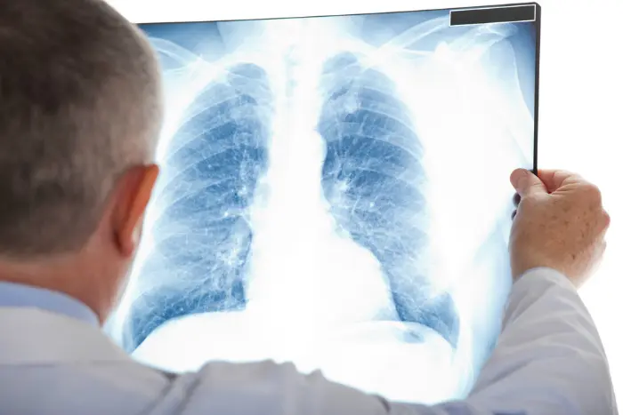 Doctor examining chest x-ray