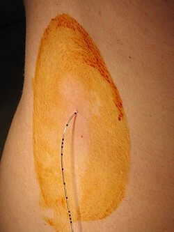 Příprava kůže pro vložení katétru při epidurální analgézi.