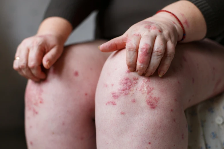 Psoriáza na kolenou a rukách s červenými skvrnami.