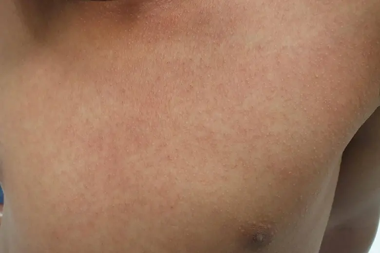 Zapálená kůže hrudníku ukazující příznaky spály.