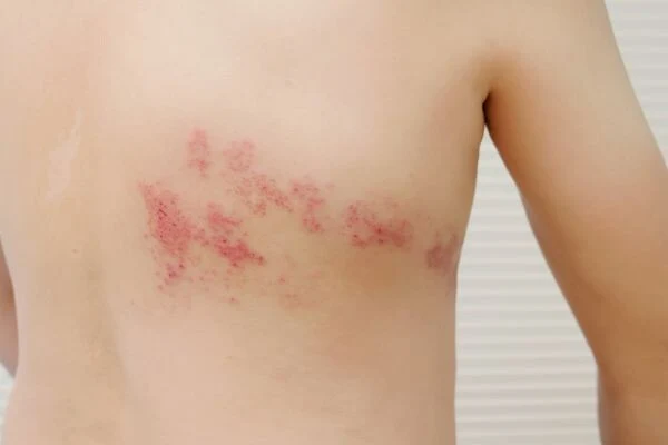 Shingles rash on back