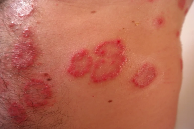 Červené šupinaté skvrny na kůži typické pro psoriázu.