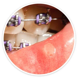 Mouth with braces and sore
