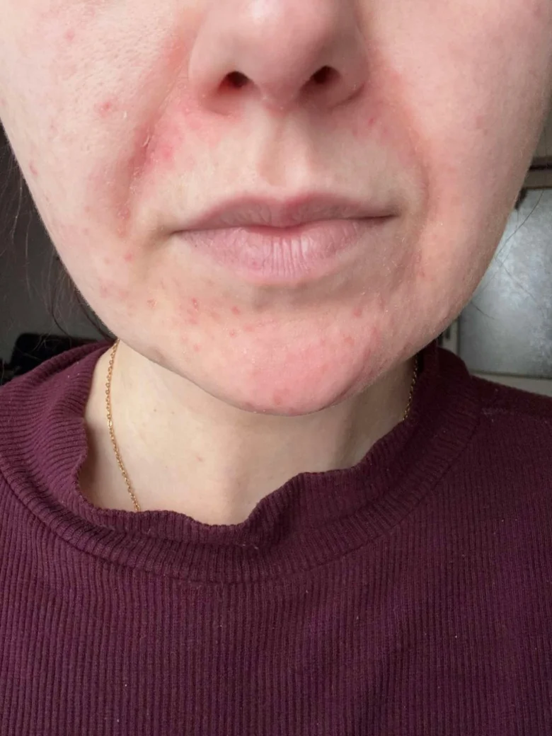 Člověk s červenou vyrážkou na obličeji způsobenou dermatitidou.