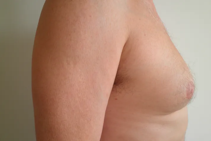 Strana muže s gynekomastií ukazující zvětšené prsní žlázy.