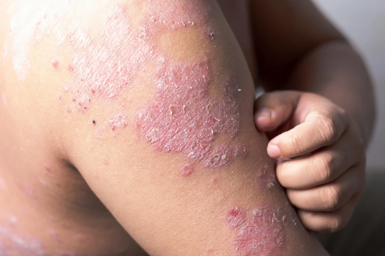 Psoriáza na lokti s červenými šupinatými skvrnami.