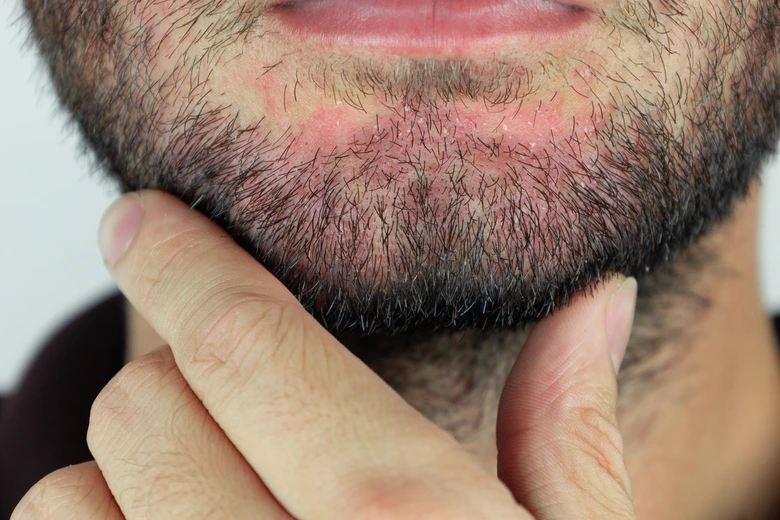 Muž s zarudlou kůží pod vousy ukazující příznaky dermatitidy.