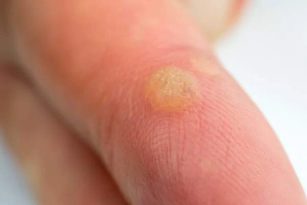 Finger wart on child's finger