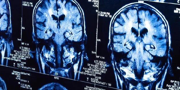 MRI snímek mozku s nádorem pro článek o příznacích.