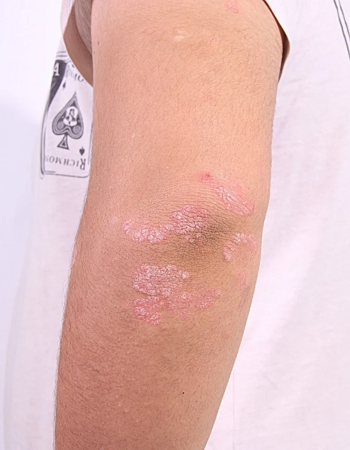 Psoriáza na lokti s červenými šupinatými skvrnami.