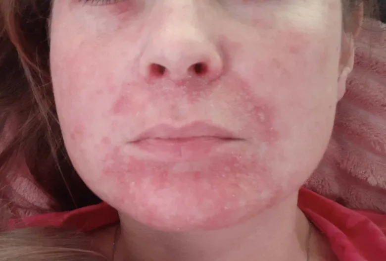 Tvář s červenou vyrážkou typickou pro dermatitidu.