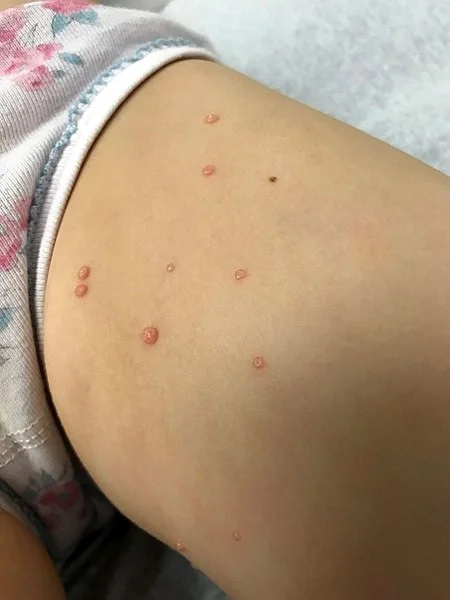 Malé pupínky s moluska na kůži dítěte nebo dospělého