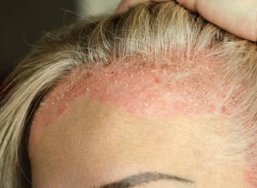 Příznaky seboroické dermatitidy na pokožce hlavy s červenými skvrnami.