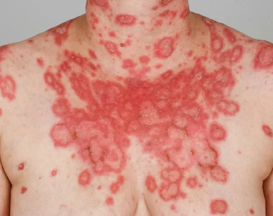Červené šupinaté skvrny na kůži typické pro psoriázu.