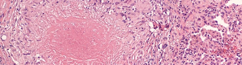 Histologický snímek ukazující oblast nekrózy v tkáni.