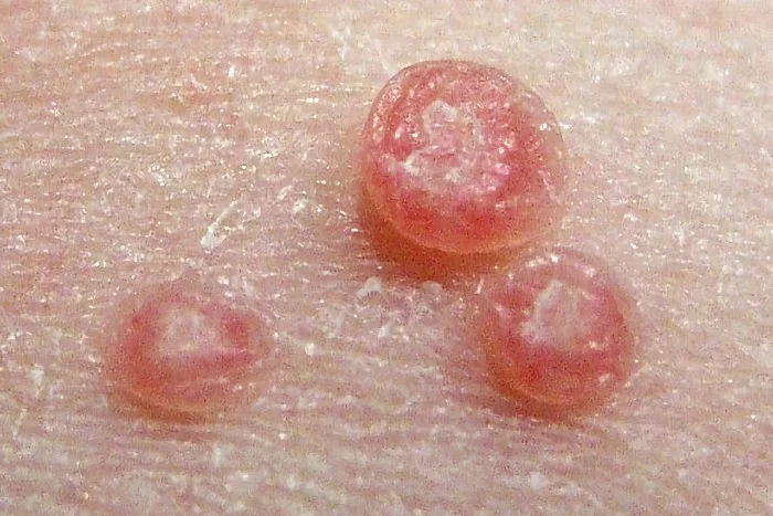 Tři růžové pupínky na kůži způsobené moluskem.
