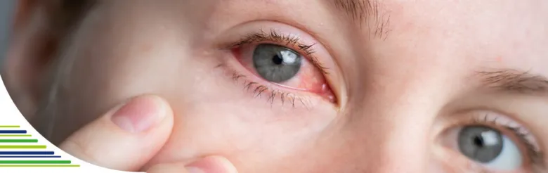 Zblízka červené oko dítěte s příznaky zánětu spojivek.