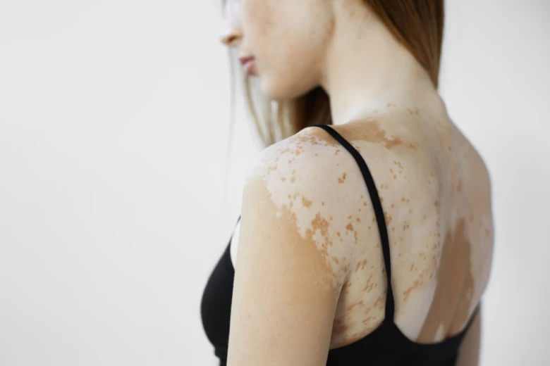 Žena s vitiligo na rameni a zádech.