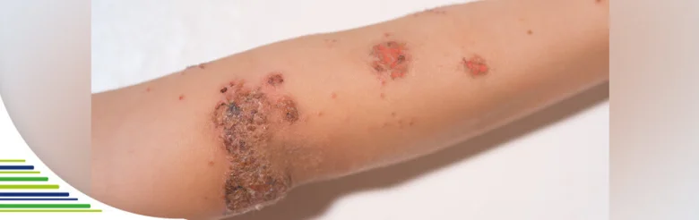 Fotografie vyrážky s krusty na předloktí jako příklad impetiga.