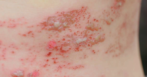Shingles rash on skin