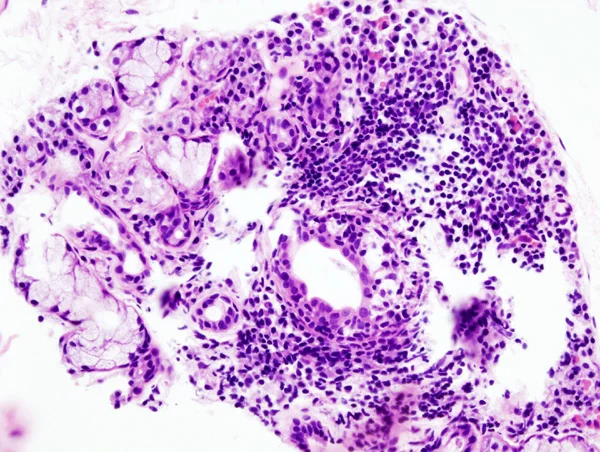 Histologický příznak Sjögrenova syndromu s lymfocytární infiltrační v slinné žláze.