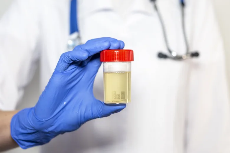 Urine sample in container