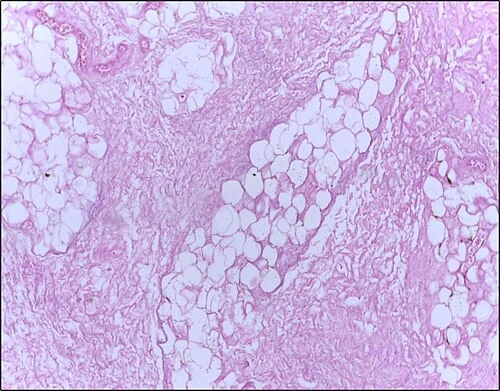 Histologický příznak nekrózy tukové tkáně s vláknitým okolím.