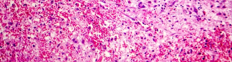Histologický snímek nekrózy tkáně s hemoragií a ztrátou jader.