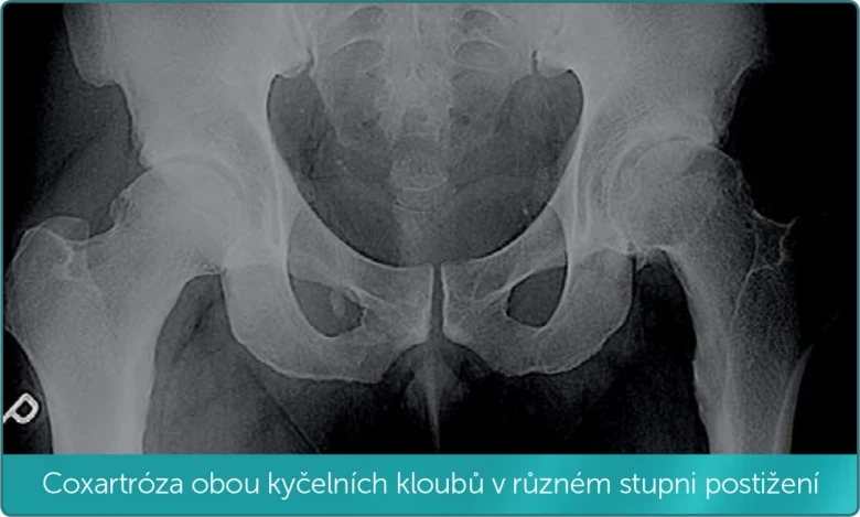 Rentgenová snímek kyčelních kloubů s artritidou