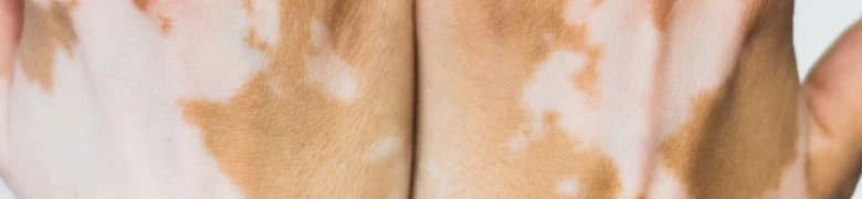 Vitiligo skin patches