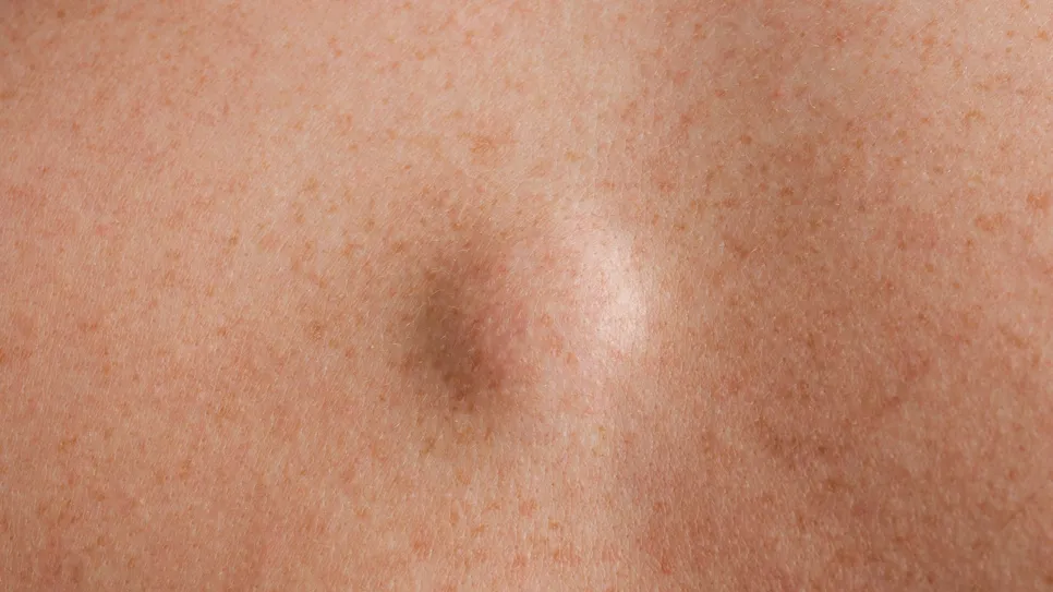Subcutaneous lump on skin