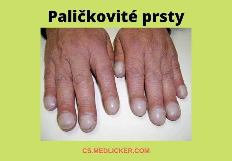 Paličkovité prsty na rukou s tlustými nehtovými plotýnky.