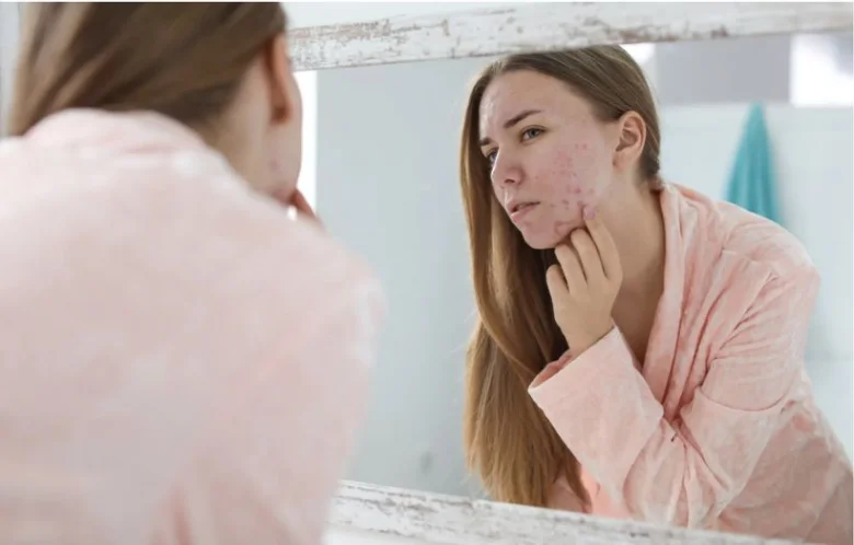 Žena se dívá do zrcadla na vyrážku způsobenou stresem.