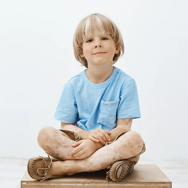 Child with vitiligo