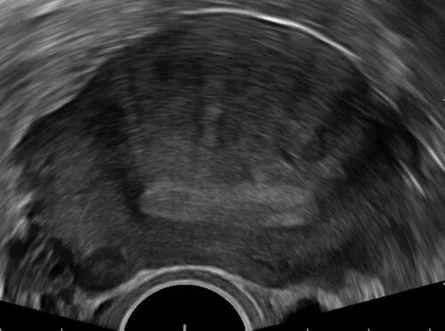 Adenomyosis ultrasound scan