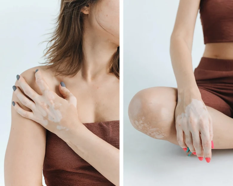 Vitiligo skin condition