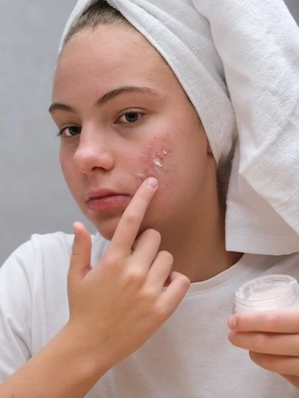 Dívka nanáší krém na tvář s vyrážkou.