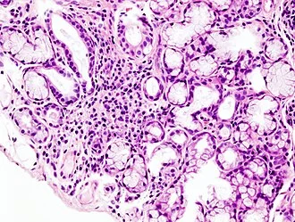 Histologický přípravek slinné žlázy s zánětem při Sjögrenově syndromu.