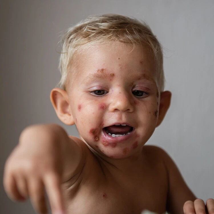 Dítě s typickými vředy na tváři způsobenými infekcí impetigem.