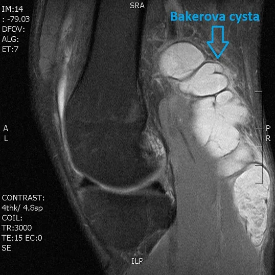 Magnetická rezonance ukazující Bakerovu cystu v kolenním kloubu.