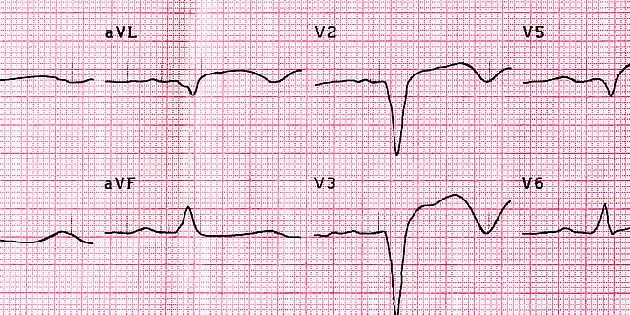 Elektrokardiogram s elevací ST v předních odvedeních ukazuje infarkt myokardu.
