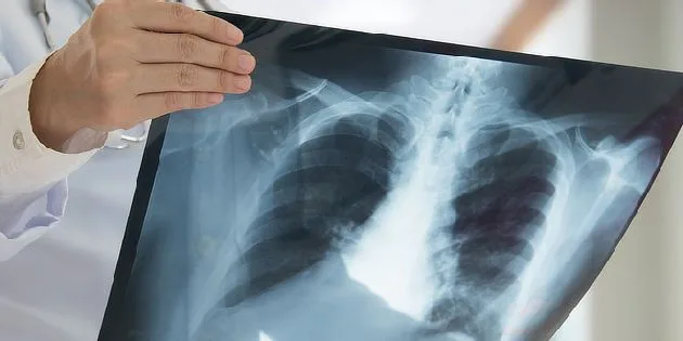 Lékař zkoumá rentgenový snímek plic pro diagnostiku CHOPN.