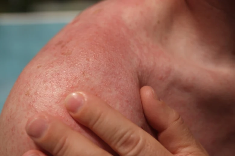 Rozšířená červená kůže na rameni po sluneční alergii.